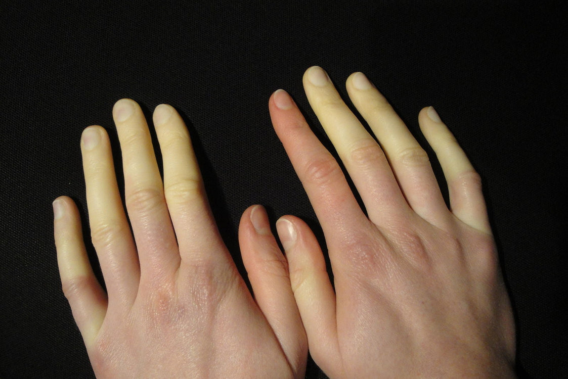 Tratamentul sindromului Raynaud cu ginseng coreean și alte plante medicinale
